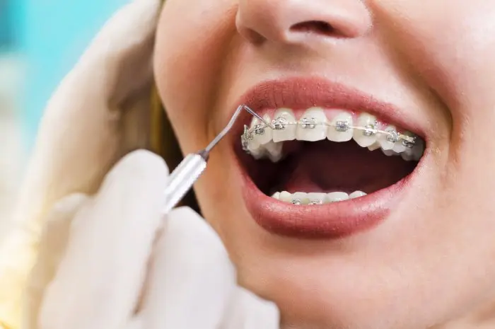 Benefits of Installing Braces